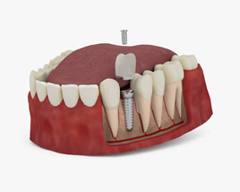 Зубной имплантат 3D модель